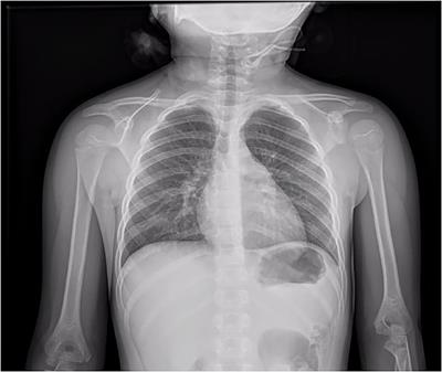 Case Report: Remdesivir and Convalescent Plasma in a Newly Acute B Lymphoblastic Leukemia Diagnosis With Concomitant Sars-CoV-2 Infection